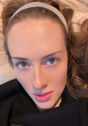 Brooke Schofield Discusses Her Forehead Changes