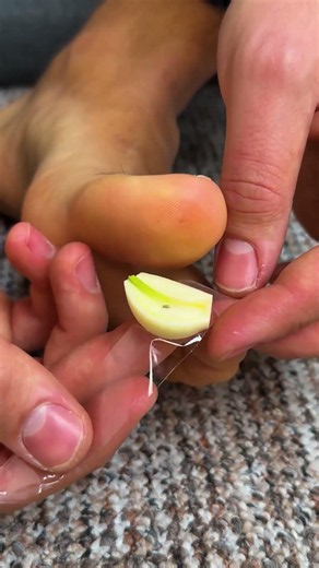 Grandma’s old school method to remove a splinter! #easy #splinter #removing