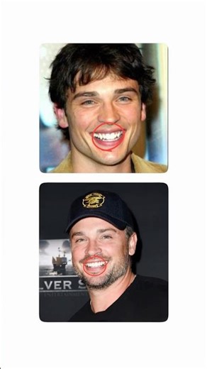 How veneers destroy the face