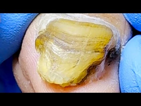 Fungus Grows Freely, Solving Foot Problems【Xue Yidao】