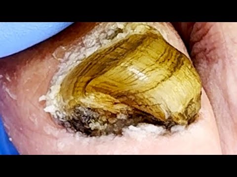 Wow~ Professional Pedicure, Cut Off Bad Nails Step By Step【Xue Yidao】