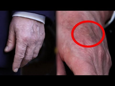 There is now a HOLE in Trump’s hand