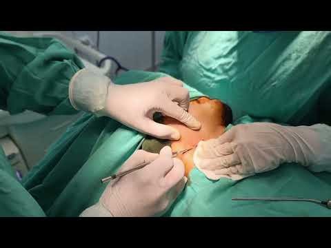 Submassetric abscess with trismus