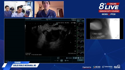 Patient 036-Carlos Robles using Precision GI