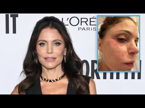 Bethenny Frankel Contracts Bacterial Infection on Face in St. Barths | E! News