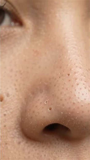 Hundreds of Blackheads on One Nose 😳 | Satisfying Cleaning