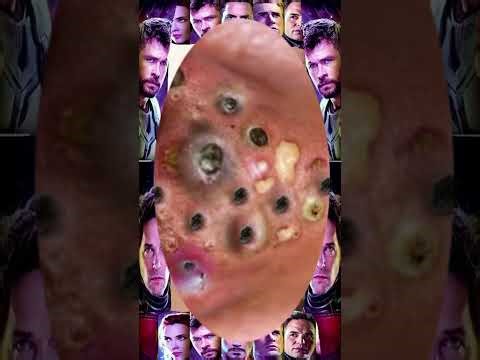 Blackheads Removal #238 | Acne Treatment and Very Satisfying Satisfying Pimple pop #blackheads