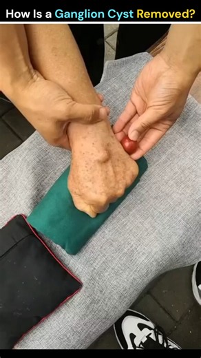 How Is a Ganglion Cyst Removed? 😱