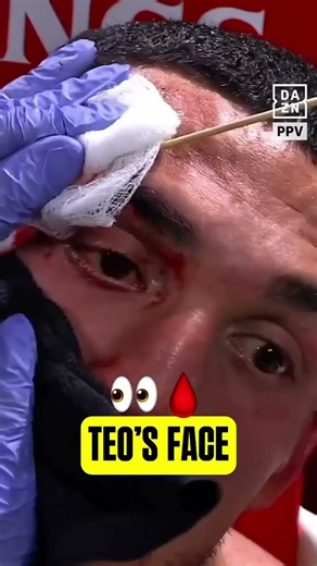 Teofimo is MARKED UP! 🩸
