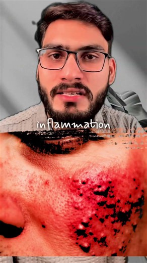 Popping Pimples? You’re Making Your Acne Worse 🚫