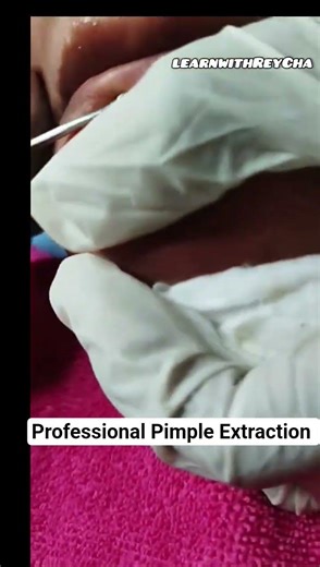 So Satisfying 😌 Professional Pimple Extraction