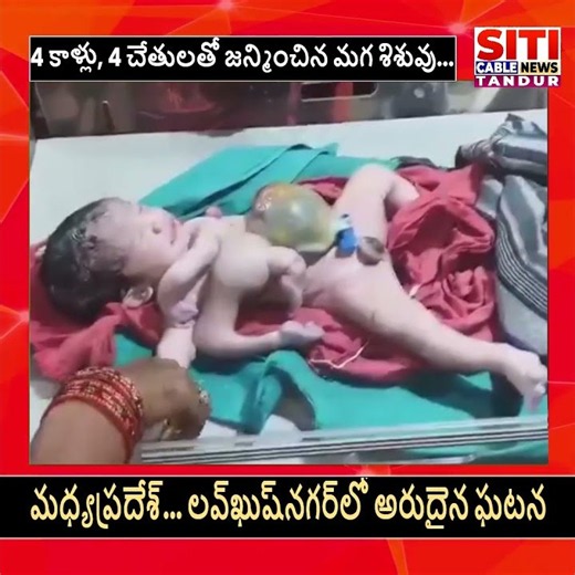మధ్యప్రదేశ్ లోని లవకుశ నగర్ లో 4 కాళ్లు 4 చేతులతో జన్మించిన మగ శిశువు