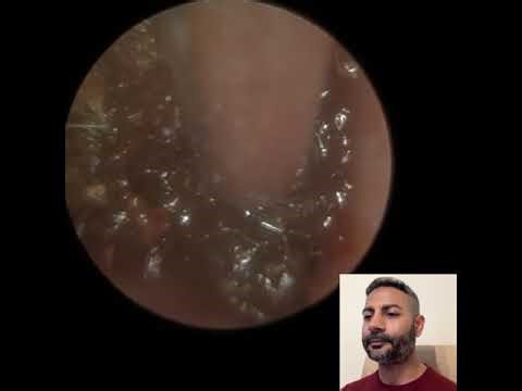 1,668 - Ear Wax Removal in Patient With Healed Eardrum Perforations | Endoscopic Procedure