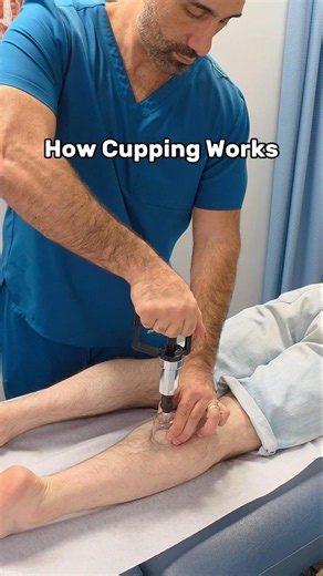 How Cupping Works