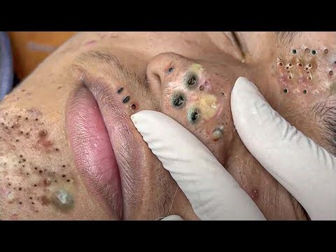 𝐁𝐢𝐠 𝐂𝐲𝐬𝐭𝐢𝐜 𝐀𝐜𝐧𝐞 𝐁𝐥𝐚𝐜𝐤𝐡𝐞𝐚𝐝𝐬 𝐄𝐱𝐭𝐫𝐚𝐜𝐭𝐢𝐨𝐧 𝐁𝐥𝐚𝐜𝐤𝐡𝐞𝐚𝐝𝐬 #𝟓𝟑𝟐𝟗68