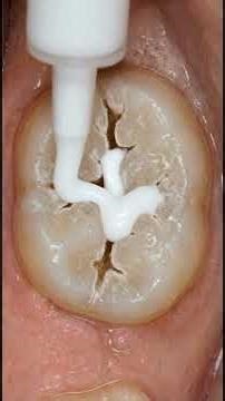 Why Dentists Pour Liquid Lava on Healthy Teeth? 🌋
