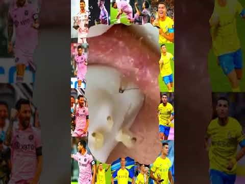 Blackheads Removal #090 | Acne Treatment and Very Satisfying Satisfying Pimple pop #blackheads