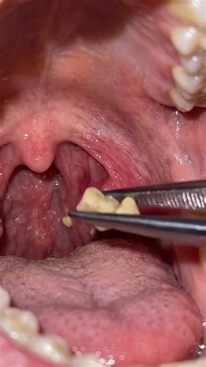 Tonsil Stones #tonsilstones #ent #oralcavity #tonsils #immunity