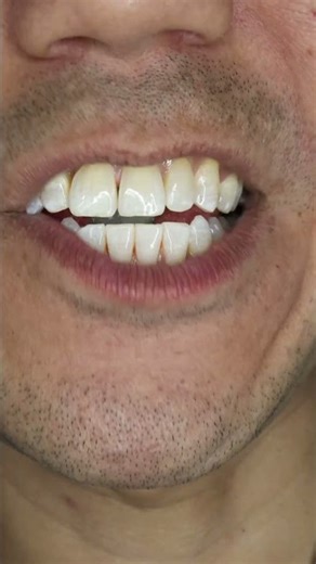 “Super Sour” Nobel Super Soda Candy ASMR #shorts #asmr