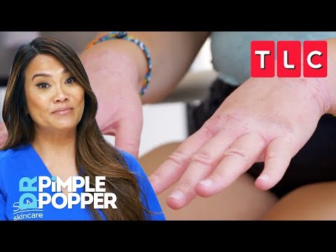 Treating the Worst Eczema Cases | Dr. Pimple Popper | TLC