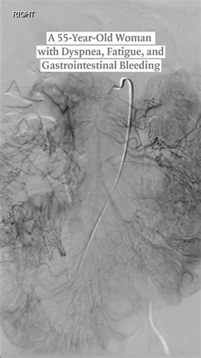 Case Record of the MGH: A 55-Year-Old Woman with Dyspnea, Fatigue, and Gastrointestinal Bleeding