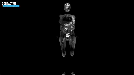 Should you pay for a whole-body MRI scan? Doctors weigh the risks