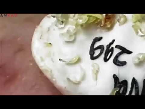 😳 EXTREME pimple extraction – not for the weak!