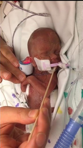 20 Weeks Premature Baby Life Journey😢😭 #prematurebaby #baby #newbornbaby #newborn #20weeksbaby