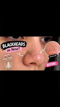 Whiteheads, Blackheads & Dull Skin? #brightskin #youtubeshorts #viral