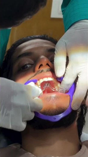 MSE (Maxillary Skeletal Expander) — fabricated with precision, placed with care.