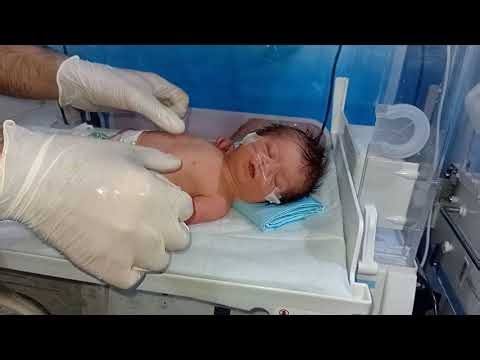 💥💢Down Syndrome with Sepsis and Congenital Heart Disease (CHD): Clinical Description and Management💫