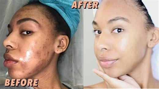 How to get rid of acne skin routine