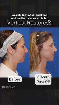 How Long Does a Vertical Restore Facelift Last?