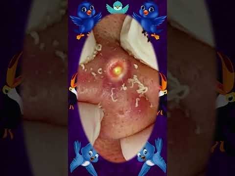 Blackheads Removal | Acne Treatment and Very Satisfying Satisfying Pimple pop #blackheads