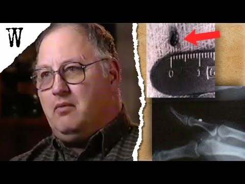 ALIEN ABDUCTION: X-Ray Revealed a Hidden Implant… Then He Remembered Everything!