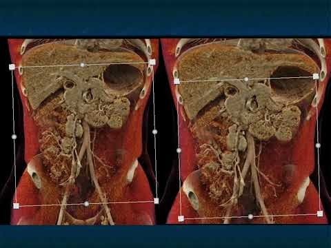 CT Evaluation of Small Bowel Obstruction: Pearls and Pitfalls in Clinical Practice - Part 6