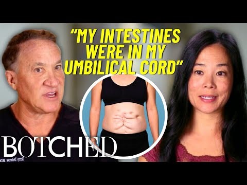 Linda’s Incredible Results After Surviving Rare Intestinal Birth Defect | Botched | E!