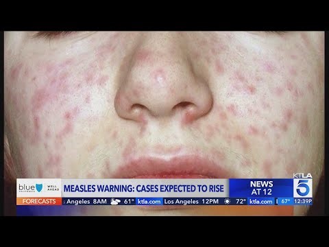 Measles warning: Cases expected to rise
