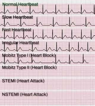 Normal vs Dangerous Heart Rhythms ❤️⚠️ | ECG Explained #Shorts #ECG #HeartAttack