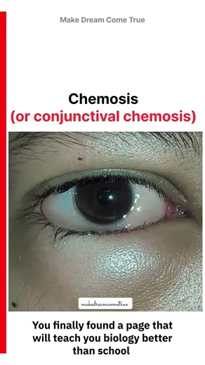 👁️ Chemosis or conjunctival chemosis 🧪| MDCT