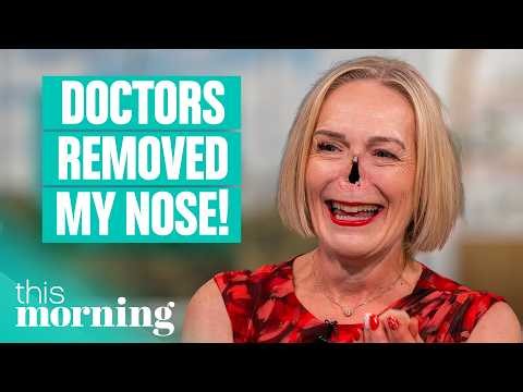 'Doctors Removed My Nose... Now I Have Multiple Prosthetics' | This Morning