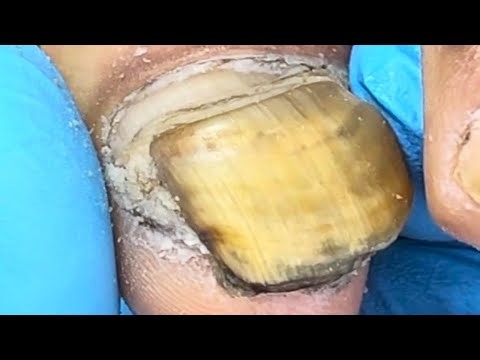 Super Thick Nails, Black Mud Hidden Inside The Nail Grooves【Podiatry Clinic】