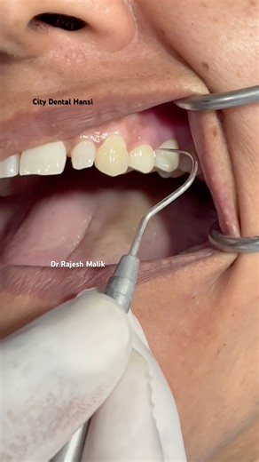 🦷 Zirconia Crown की Perfect Fitting | Explorer से Marginal Check ✨#dentalshorts #zirconia #crown