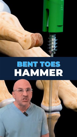 Choosing the Right Hammertoe Procedure #orthopedicsurgery