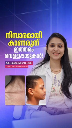 Cutis International Cosmetic Clinic on Instagram: "നിസാരമായി കാണരുത് ഇത്തരം വെള്ളപ്പാടുകൾ! For package details, kindly contact us. ☎️ Trivandrum +91 97454 33344 ☎️ Kochi +91 94463 56615 ☎️ Calicut +91 79942 33344 ☎️ Kottakkal +91 96569 33344 ☎️ Bengaluru +91 99800 01291 ☎️ Hyderabad +91 73566 33344 ☎️ UAE +971 50892 2720 ☎️ Oman +968 9667 5109 . . #cutis #CutisInternational #hairtransplantation #skinclinic #SkinFungus #fungalinfectiontreatment #SkinInfection #TineaVersicolor #PityriasisVersicolo