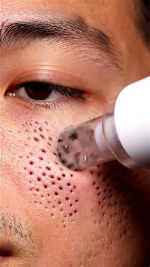 “Most Satisfying Blackhead Vacuum Extraction Ever! Real Deep Pore Cleaning ASMR for Stress Relief,