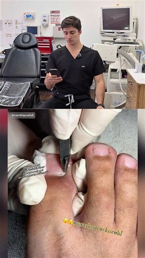 Perfect Ingrown Toenail Removal