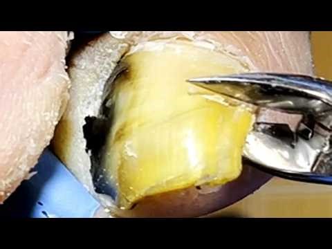 Very Long Toenail Trimming, Complete Pedicure Process【Podiatry Clinic】