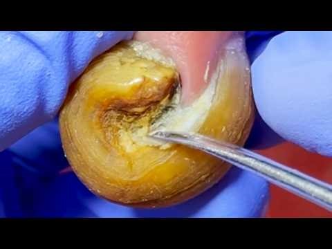 The Nails Are Curled Like A Snail Shell And Are Perfectly Manicured!【Dr. Liu's Pedicur】