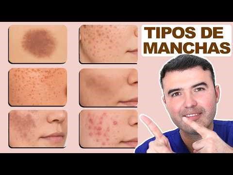 Goodbye Spots: 4 Steps to Beat Melasma (Insulin, Hormones and Avoiding Toxic Chemicals)